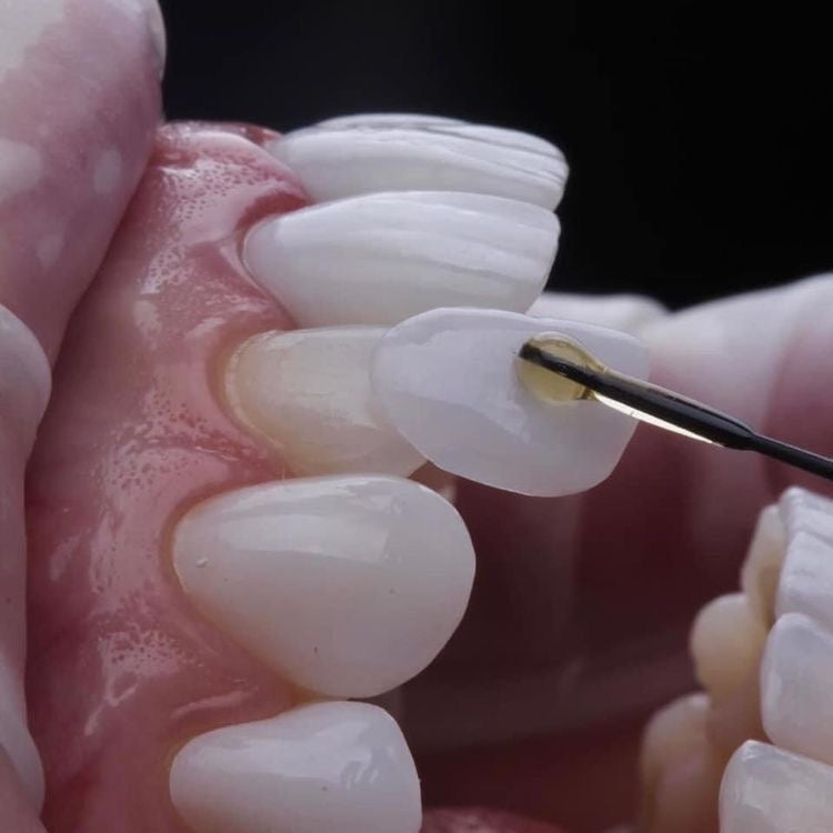 CARILLAS DE RESINA Y PORCELANA CHAIRSIDE : UNA NUEVA GENERACIÓN DE ESTÉTICA DENTAL