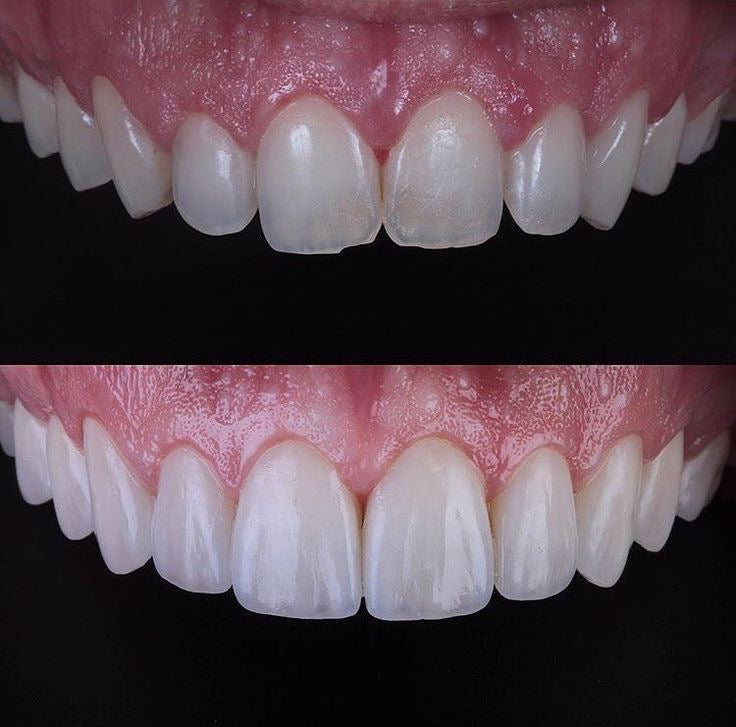 CARILLAS DE RESINA Y PORCELANA CHAIRSIDE : UNA NUEVA GENERACIÓN DE ESTÉTICA DENTAL